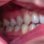 a person's mouth with teeth showing