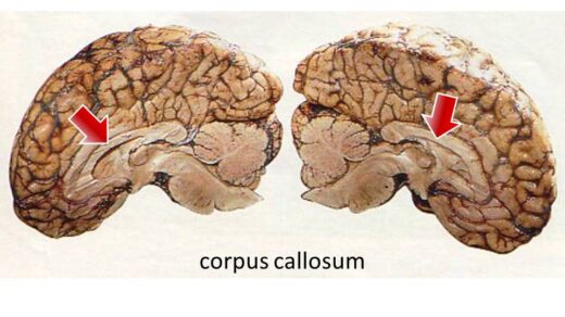 split brain surgery