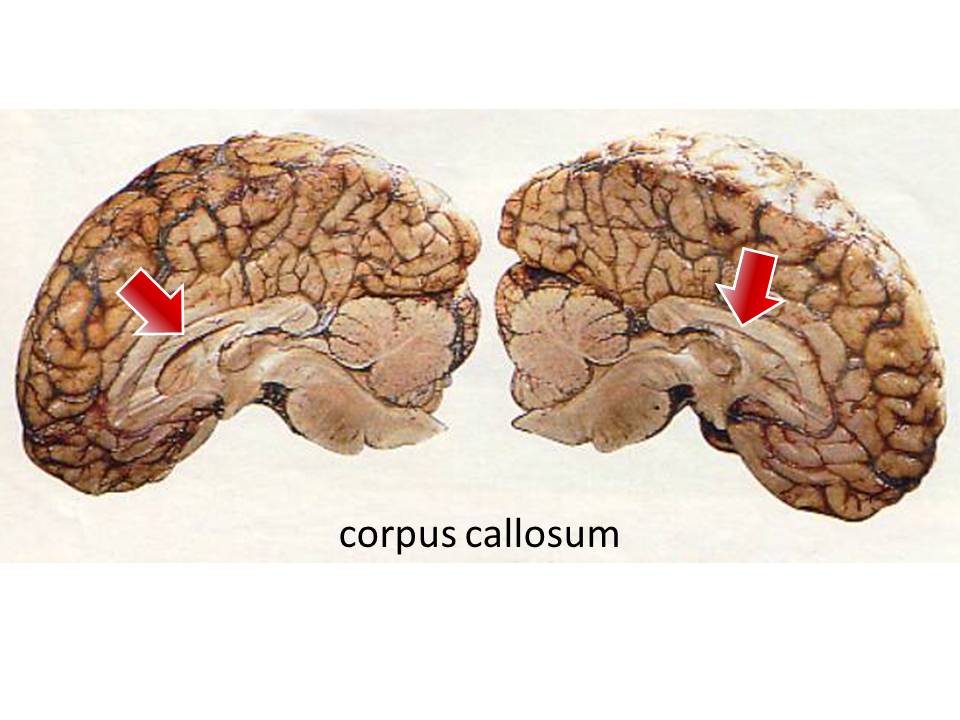 split brain surgery