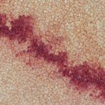 Measles