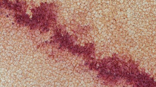 Measles