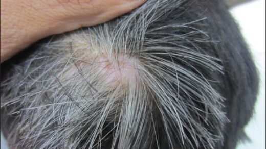 Can Gray Hair Be Reversed?