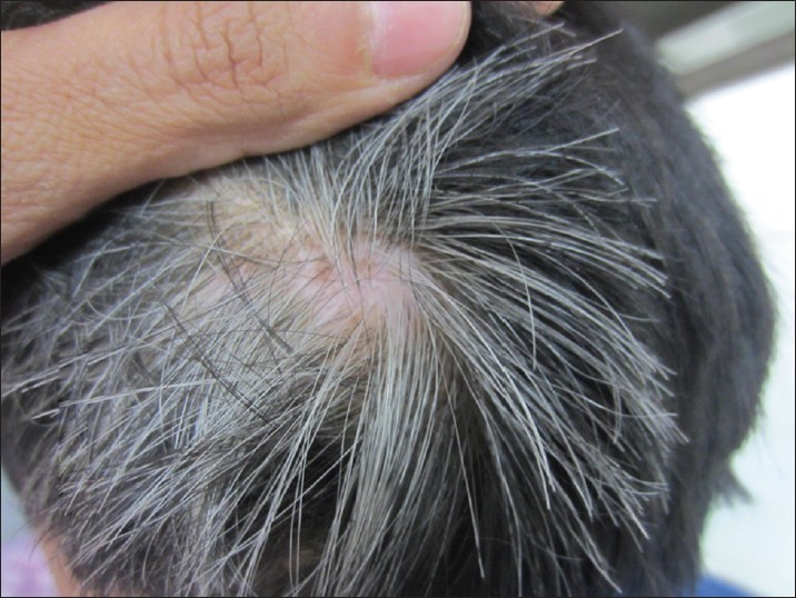 Can Gray Hair Be Reversed?