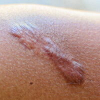 Skin Scars Become Thick