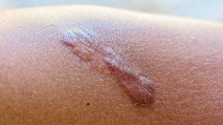 Skin Scars Become Thick