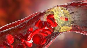 microplastic in human arteries