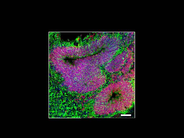 Lab-Grown Mini Brains Are Finally Revealing What Causes Autism