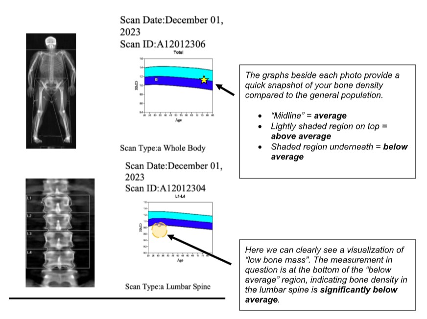How Do I Read a DXA Bone Density Report? | Men's Health Boston