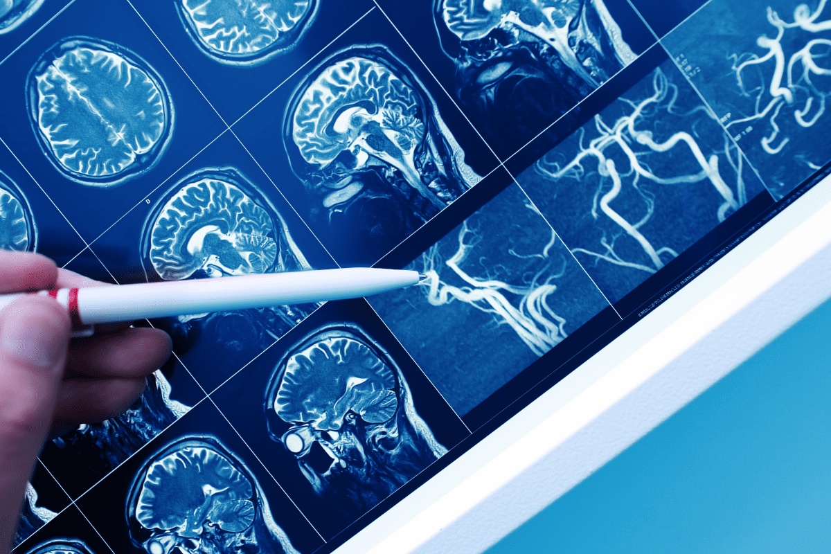 The Blood Test That Could See Dementia Coming 25 Years Early