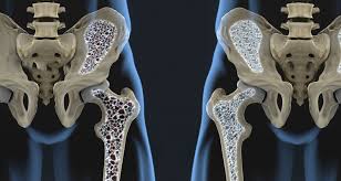 primed stem cells osteoporosis