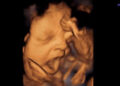 Babies Yawn in the Womb
