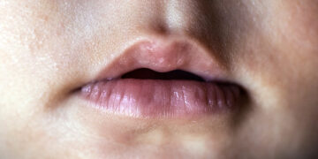 Parents Blame Lip-Ties for Nursing Struggles, But Study Highlights Maternal Experience